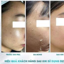 peel da bong trong mấy ngày