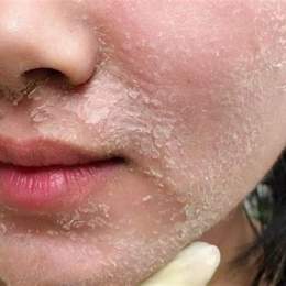 peel tảo có bong da không