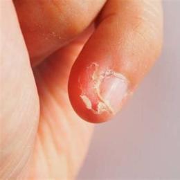 tay bị bong da là bị sao