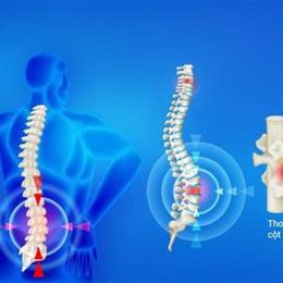 thoát vị đĩa đệm có đá bóng được không