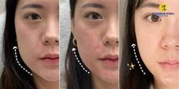 tính năng nổi bật ảnh da mặt căng bóng