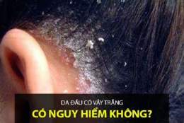 tính năng nổi bật bị bong da đầu