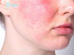 tính năng nổi bật bị bỏng lột da phải làm sao