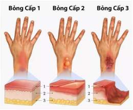 tính năng nổi bật bỏng dạ là gì