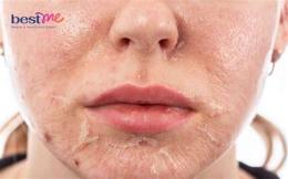 tính năng nổi bật bỏng da nên làm gì