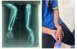 tính năng nổi bật bong da tay ở trẻ em