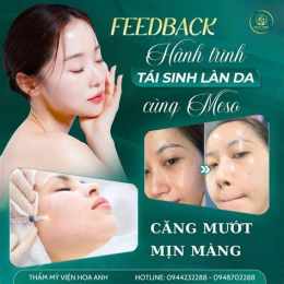 tính năng nổi bật cấy căng bóng da