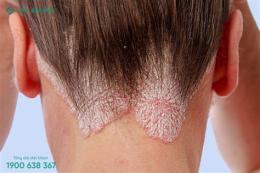 tính năng nổi bật da đầu bị ngứa và bong vảy