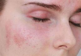 tính năng nổi bật da mặt bị đỏ ngứa bong tróc