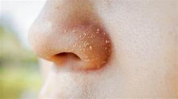 tính năng nổi bật da mũi bị khô bong tróc
