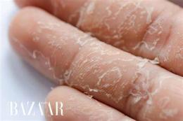 tính năng nổi bật hay bị bong da tay là thiếu chất gì