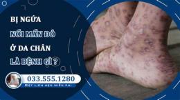tính năng nổi bật kẽ chân bị ngứa bong da