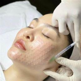 tính năng nổi bật liệu trình mesotherapy trẻ hóa căng bóng da