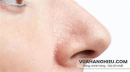 tính năng nổi bật mũi bị bong da