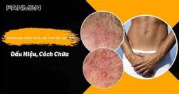 tính năng nổi bật ngứa bong da vùng kín nam giới