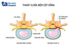 tính năng nổi bật thoát vị đĩa đệm có đá bóng được không