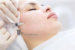 tính năng nổi bật tiêm căng bóng da