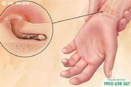 tính năng nổi bật viêm da bọng nước