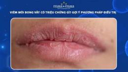 tính năng nổi bật viêm da môi bong vảy
