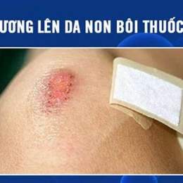 vết bỏng lên da non bôi gì