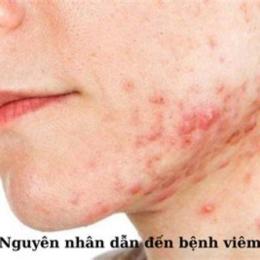 viêm da bọng nước